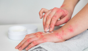 Quick Guide On Psoriasis, Causes, Symptoms, Trigger, Treatment, And More